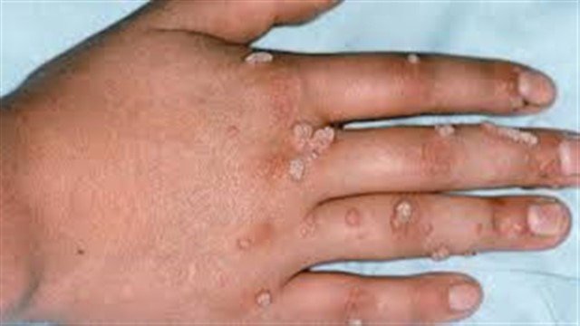 sigil belirtileri saglik