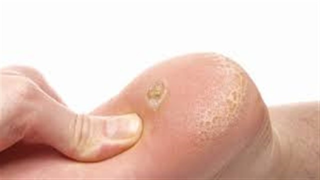 sigil nedenleri saglik