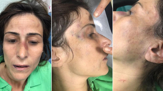 Doktor eşinin kemiklerini kıran kocanın cezası belli oldu