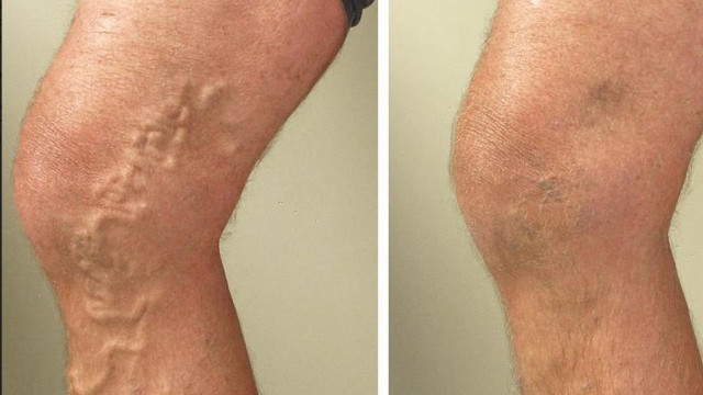 ameliyatsiz varis tedavisi her tur