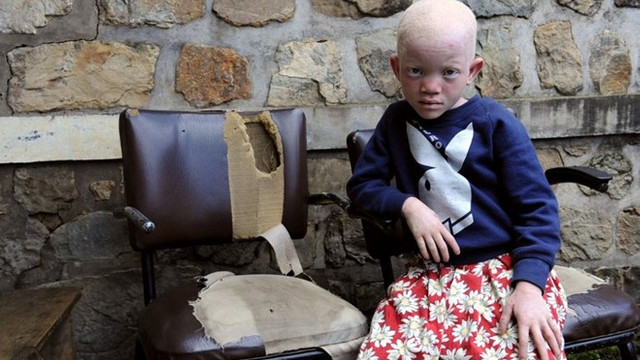 Albino çocuğun elini kestiler ! Sebebi tüyler ürpertiyor