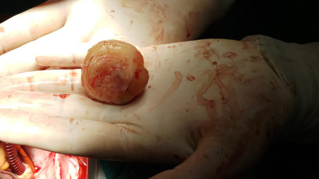 Kalbinden çıkarıldı doktorlar bile şoke oldu