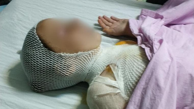 8 yaşındaki Elif'in üzerine süt tenceresi döküldü