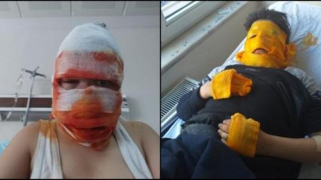 Sprey kutusu patladı ! Yüzü feci şekilde yandı
