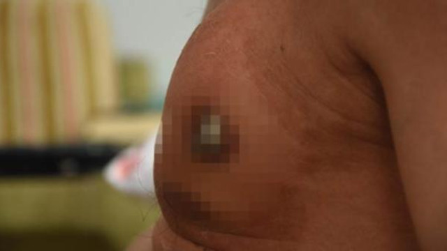 Ameliyat olmayı beklerken göğsünden dışarı fırladı !