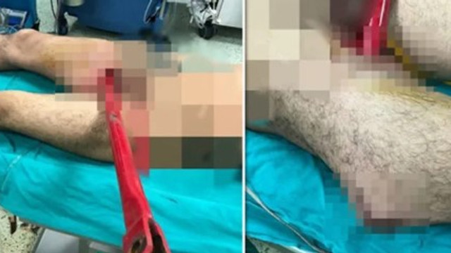 Bacağına pulluk demiri saplandı !