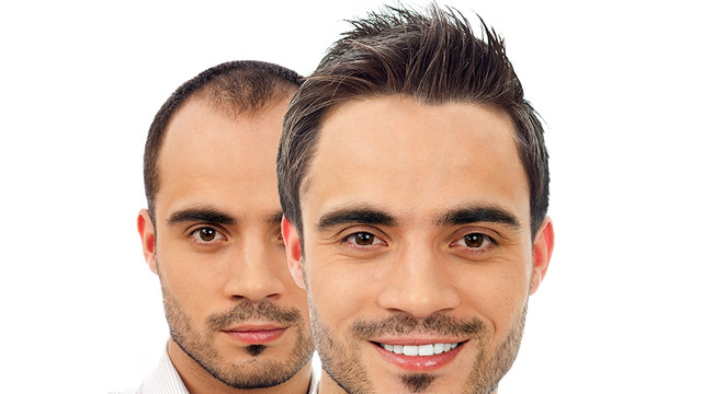 Sac Ekimi Operasyonu Hastane Ortaminda Yapilmali Saglik