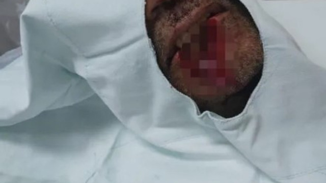 Isırarak kayınpederinin dudağını koparmıştı... Tutuklandı !
