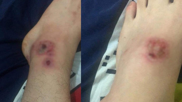 Bu sivrisinek başka sivrisinek ! Her gün artıyor...
