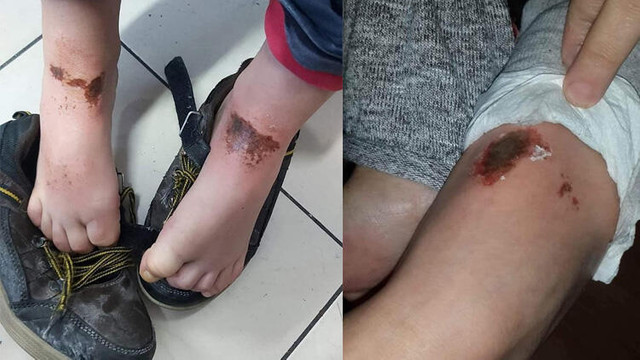 Kar oynarken vücutları yanan çocuklarla ilgili yeni açıklama