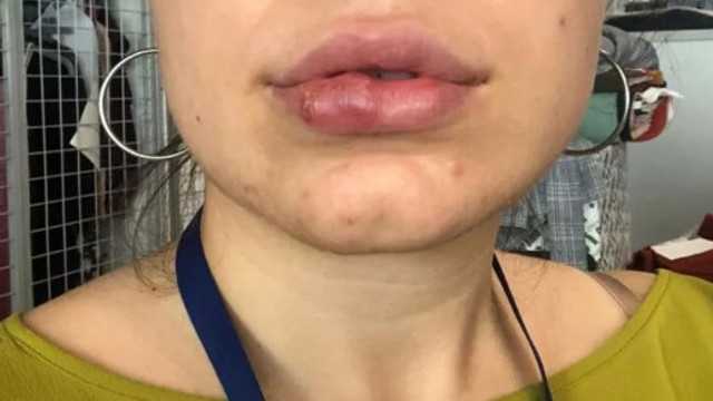 Dudak Dolgusu Yaptiran Genc Kizin Hayati Karardi Guncel