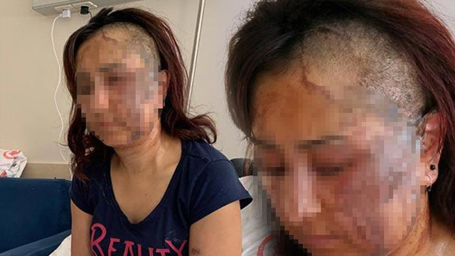 Vicdansız adam boşanmak isteyen eşine kezzapla saldırdı!
