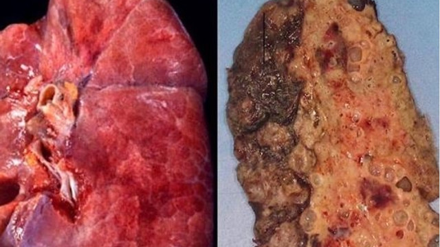 Koronavirüsün akciğerlere verdiği hasarın en net görüntüsü