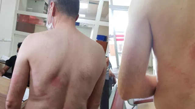 Lisede skandal! Engelli öğretmen kendisine sıcak çay fırlatan müdürden şikayetçi oldu