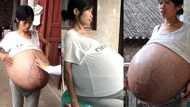 Doktorlar şaşkın! Karnında 20 kiloluk kütleyle yaşıyor