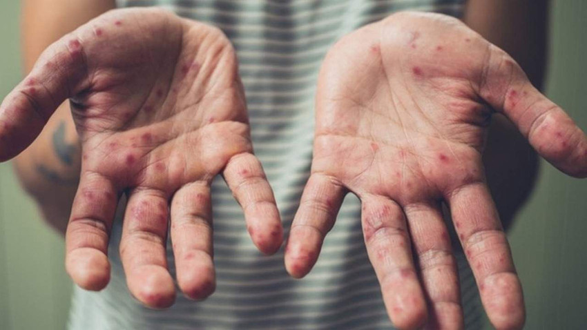 Uzmanlardan korkutan uyarı: Kapı kolundan, kağıttan, paradan bulaşabilir! - Resim: 1