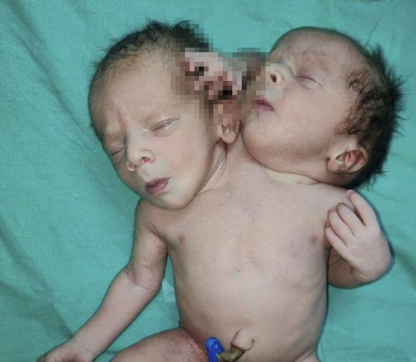 İkiz bebek bekleyen aile gerçeği öğrenince şok geçirdi - Resim : 1