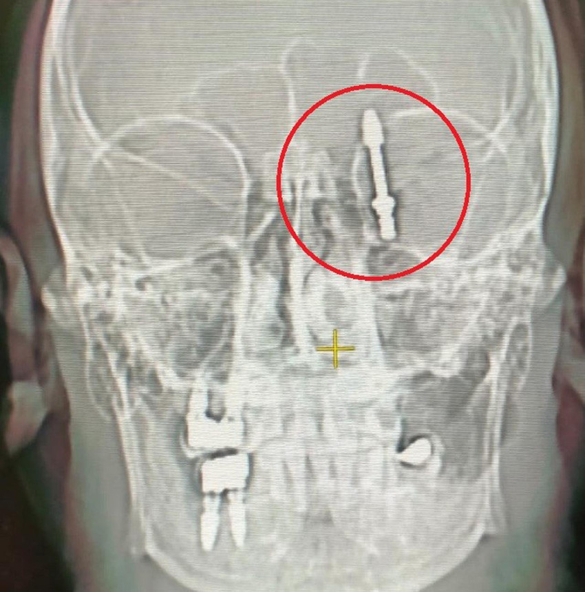 Bursa'da özel bir klinikte implant tedavisi sırasında korkunç bir olay yaşandı. Doktor çeneye yerleştirilecek vidayı zorlayınca vida çene kemiğini delip hastanın beynine saplandı. Hastaneye kaldırılan adam saatler süren ameliyat sonrası hayata döndü.
