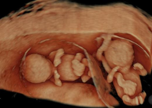 Ultrasonda çığır açtılar; 4 boyutlu mucize