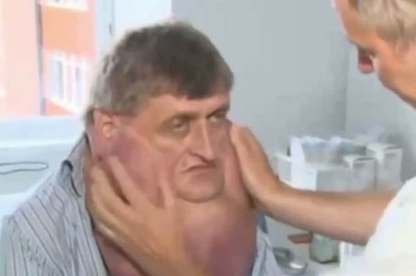 Tümörlü adamın dramı