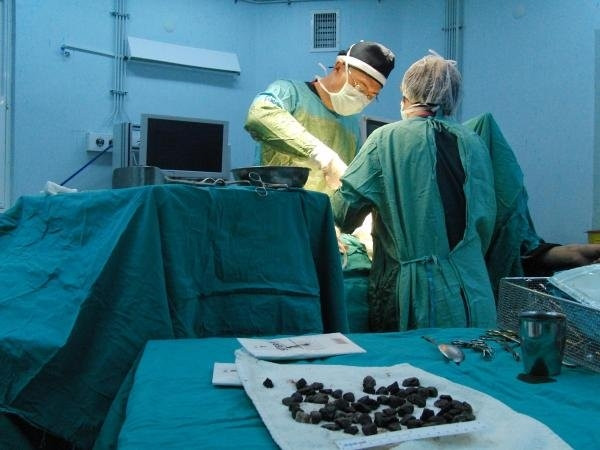 Midesinden 82 parça taş çıkarıldı