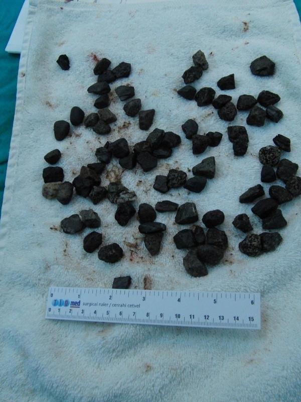 Midesinden 82 parça taş çıkarıldı