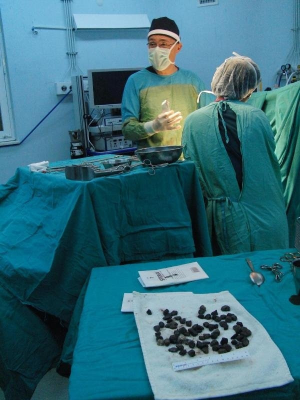Midesinden 82 parça taş çıkarıldı