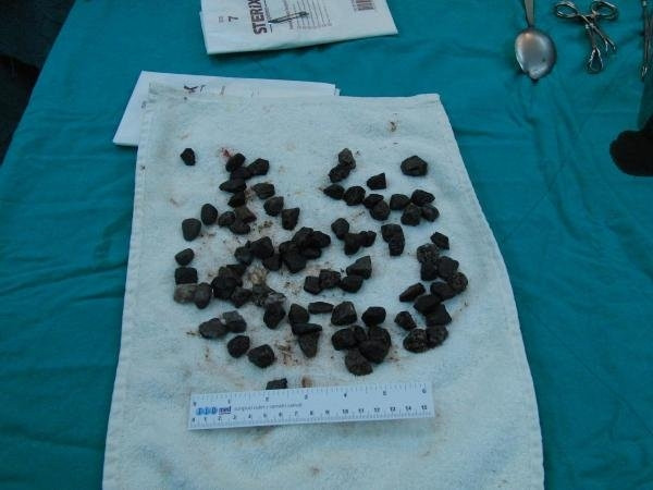 Midesinden 82 parça taş çıkarıldı