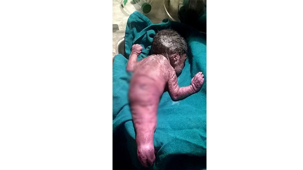 Deniz kızı bedeniyle dünyaya geldi !
