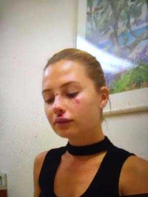 Serdar Ortaç'ın eşi Chloe dayak mı yedi ?