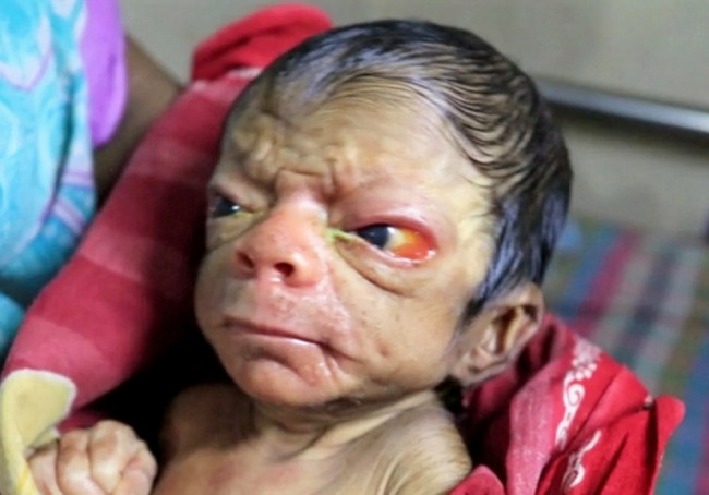 Gerçek Benjamin Button doğdu