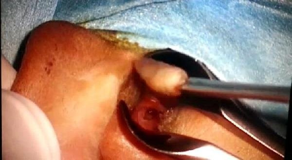 Küçük çocuğun kulağından bakın ne çıktı