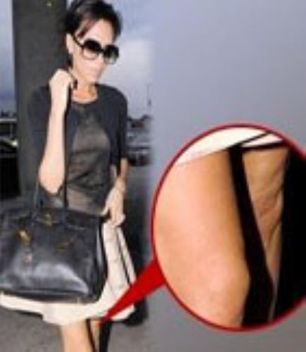 Victoria Beckhamın selülitleri