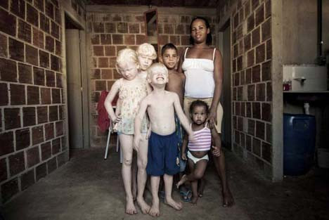 Dünyayı şaşırtan albino kardeşler