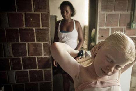 Dünyayı şaşırtan albino kardeşler