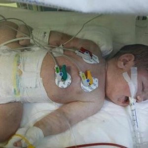 O bebek 76 gün sonra hayatını kaybetti