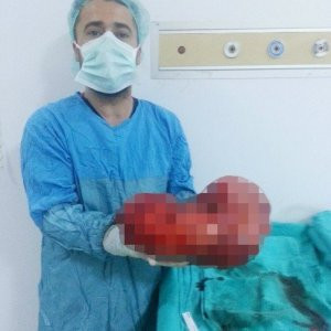 Hastanın karnından bakın ne çıktı...