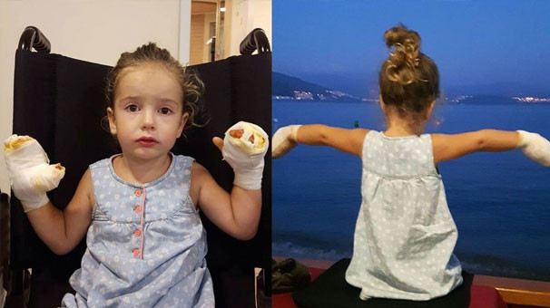 Uçan balon 3 yaşındaki Mira'yı yaktı !