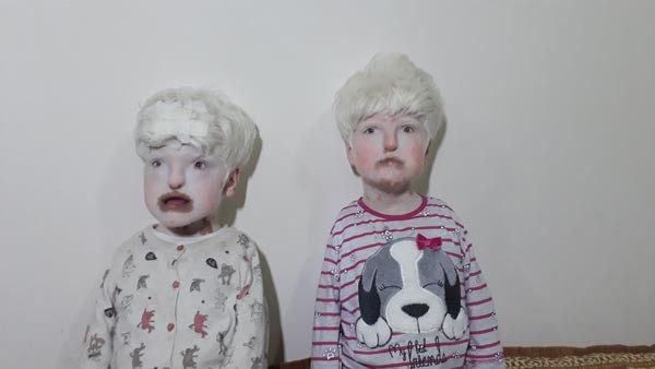 Albino kardeşlerin dramı