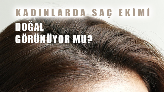 Kadınlarda saç ekimi doğal görünür mü?