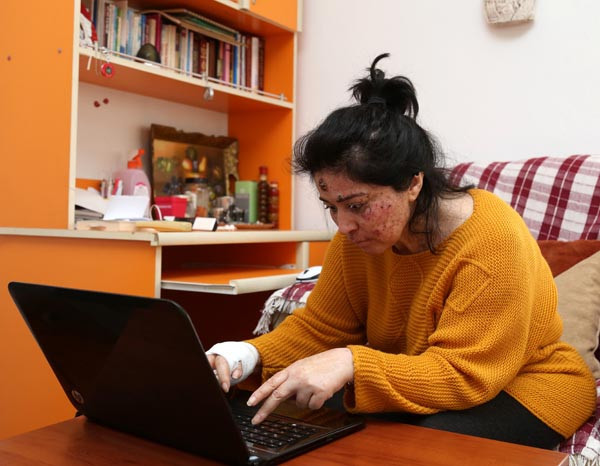 Günden güne eriyor... Şimdi de elini kaybetti !