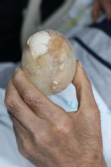 Mesanesinden yarım kiloluk taş çıktı