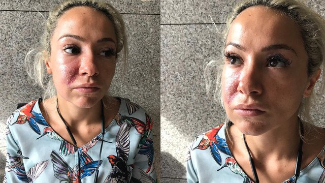 Istanbul Un Unlu Kliniginde Estetik Faciasi Kadin