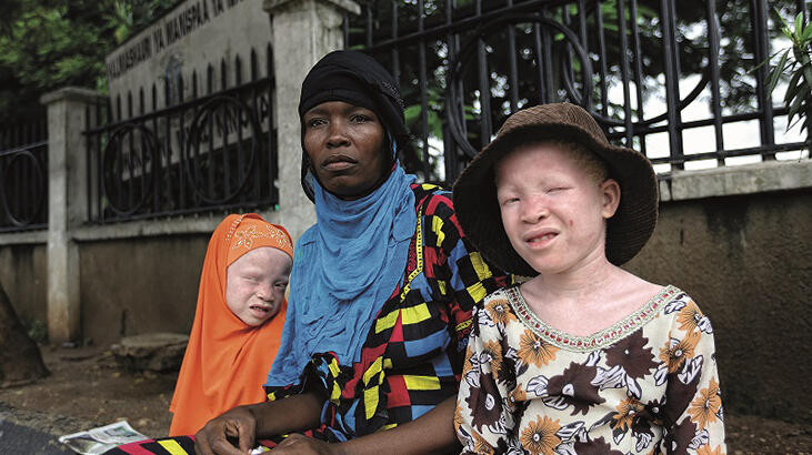 Afrikalı albinoların dramı sanatseverler ile buluşacak