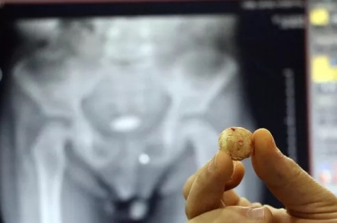 3 yaşındaki çocuğun mesanesinden çıktı! - Resim : 1