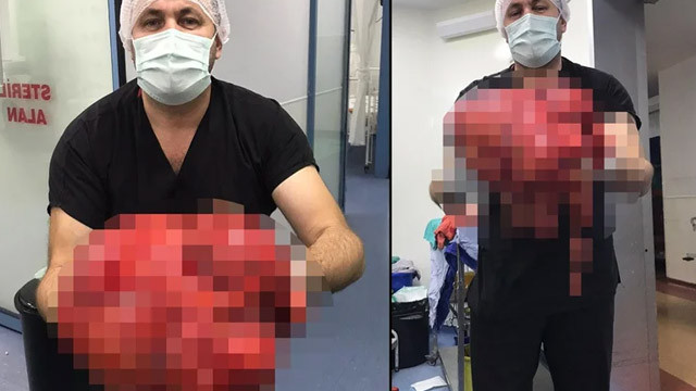 Karnından çıkanlar şoke etti! 14 kilogram...