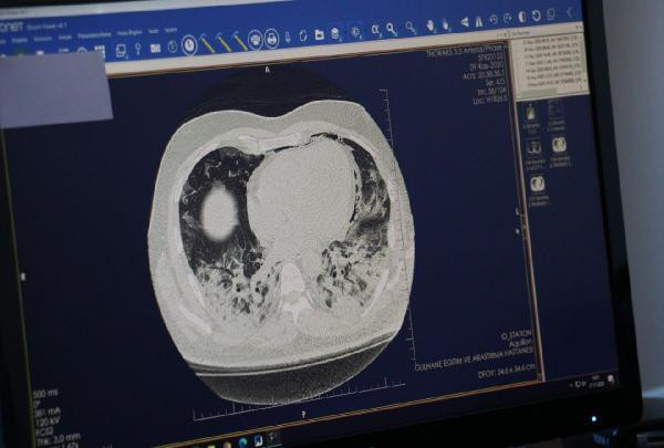Koronavirüsün akciğerdeki hasarı tomografi ile görüntülendi - Resim: 2