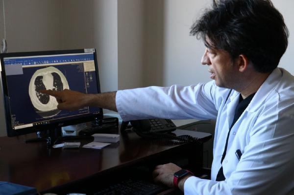 Koronavirüsün akciğerdeki hasarı tomografi ile görüntülendi - Resim: 3
