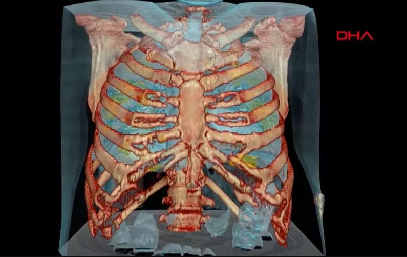 İşte koronavirüs bulunan akciğerin 3D görüntüsü !