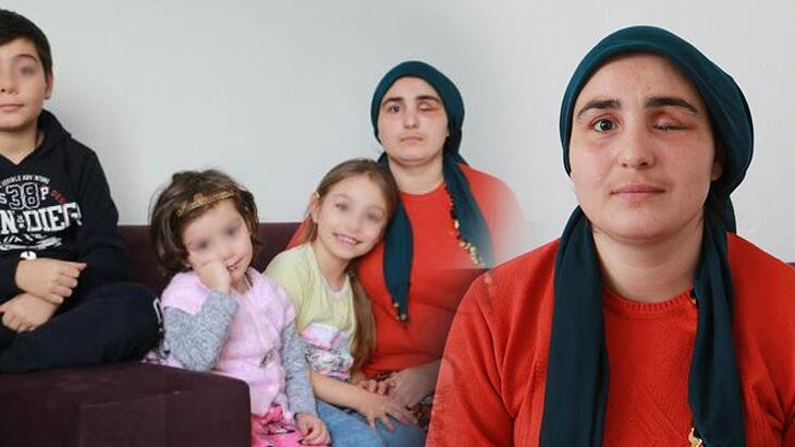 Eşinin şiddetinden gözünü kaybetti